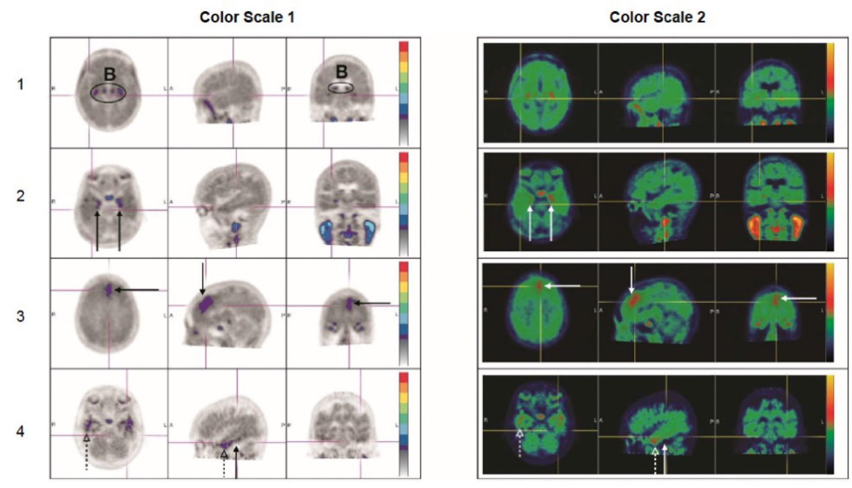 Two negative brain scans––a black and white scan and a colorful scan
