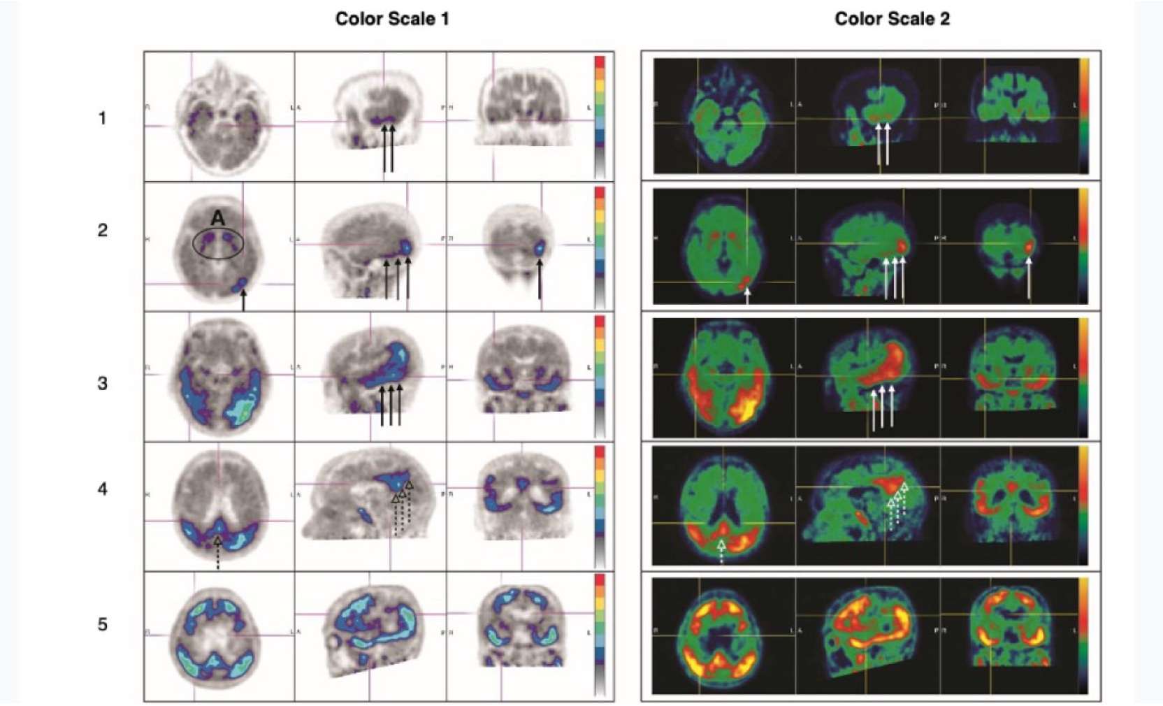 Two positive brain scans––a black and white scan and a colorful scan